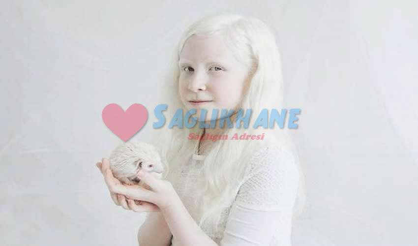 Albino hastalığı