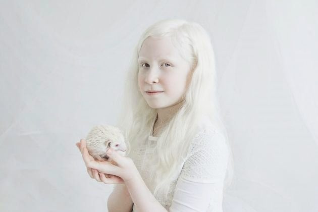 Albino Hastalığı Nedir, Neden Olur, Belirtileri Nelerdir?